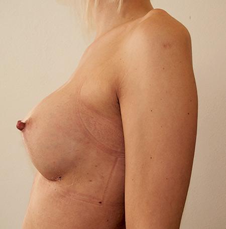 Zvětšení prsou