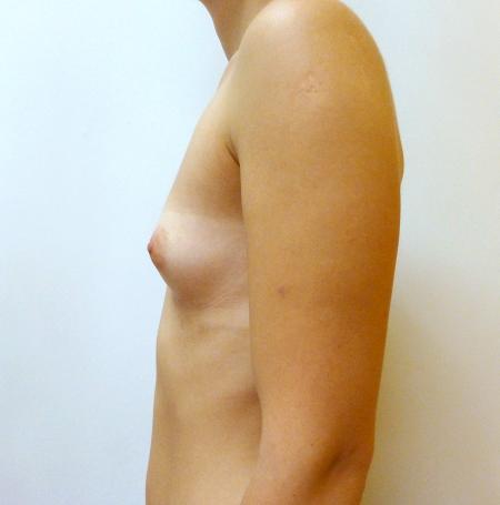 Zvětšení prsou s implantáty - přirozené zvětšení